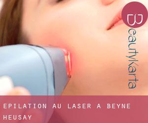 Épilation au laser à Beyne-Heusay