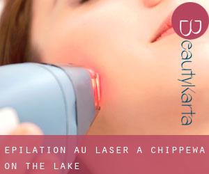 Épilation au laser à Chippewa-on-the-Lake