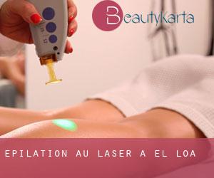 Épilation au laser à El Loa